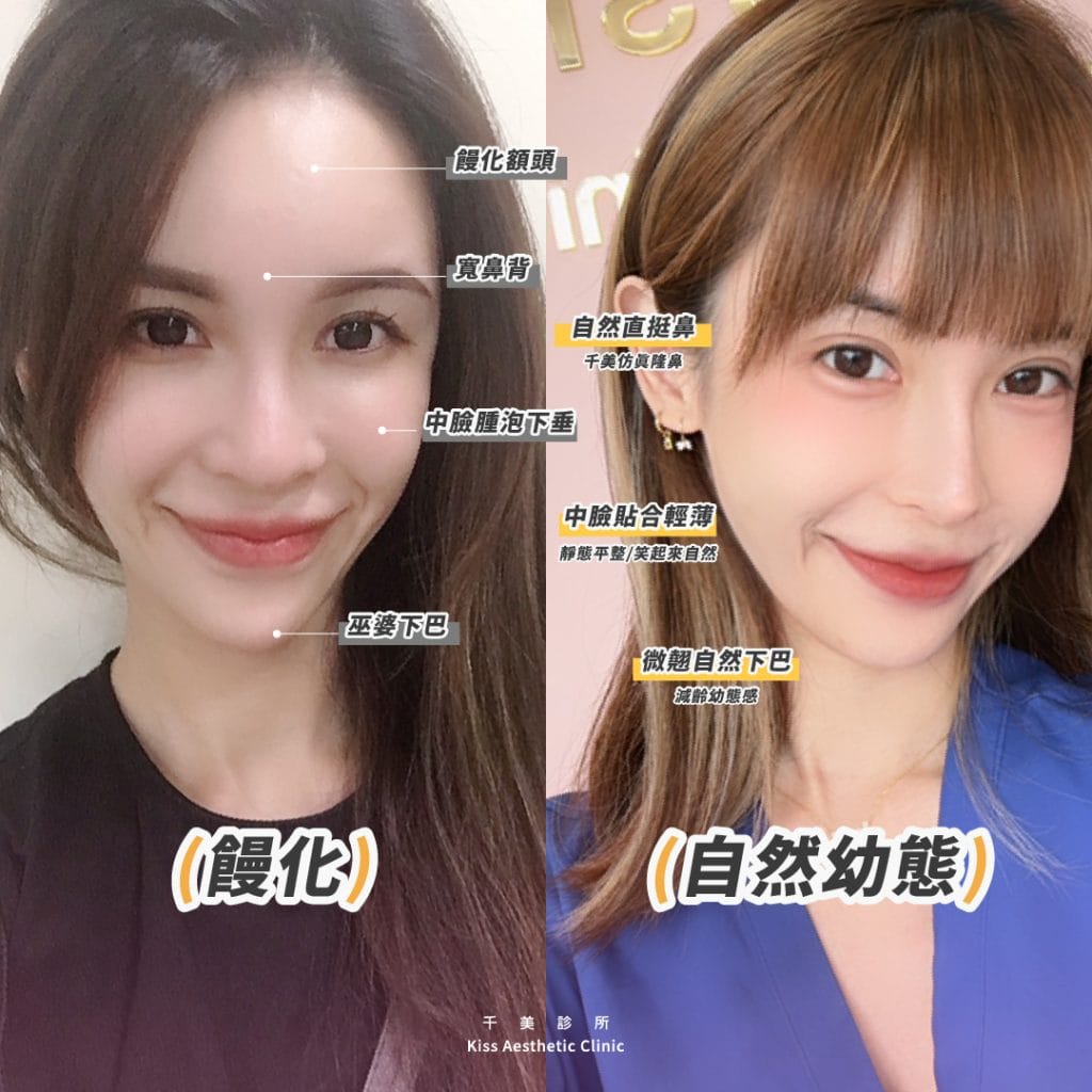 【千美饅化減法治療】枕頭臉?饅頭臉?饅化臉?如何避免饅化