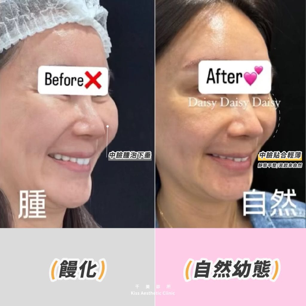 【千美饅化減法治療】枕頭臉?饅頭臉?饅化臉?如何避免饅化